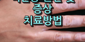 백반증 원인 및 증상
