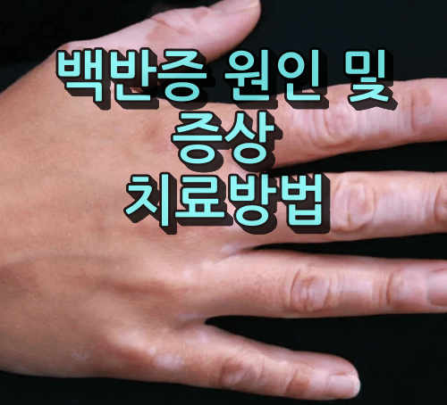 백반증 원인 및 증상